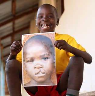 Image of a child in Tanzania helped by Smile Train